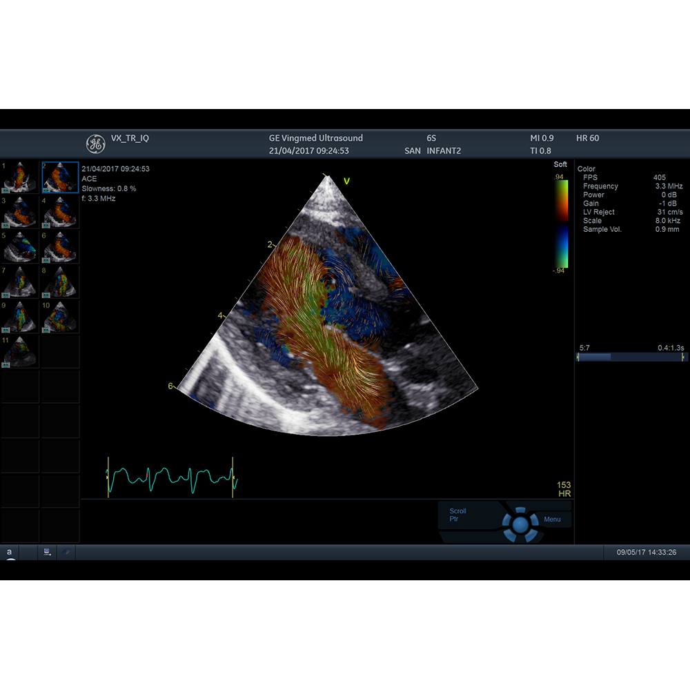 Blood Speckle Imaging (BSI) on Vivid Blood Speckle Imaging (BSI) on Vivid